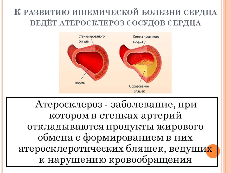 Ишемическая болезнь сердца и инфаркт миокарда