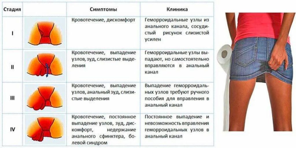 Геморрой симптомы и лечение у женщин причины возникновения картинки