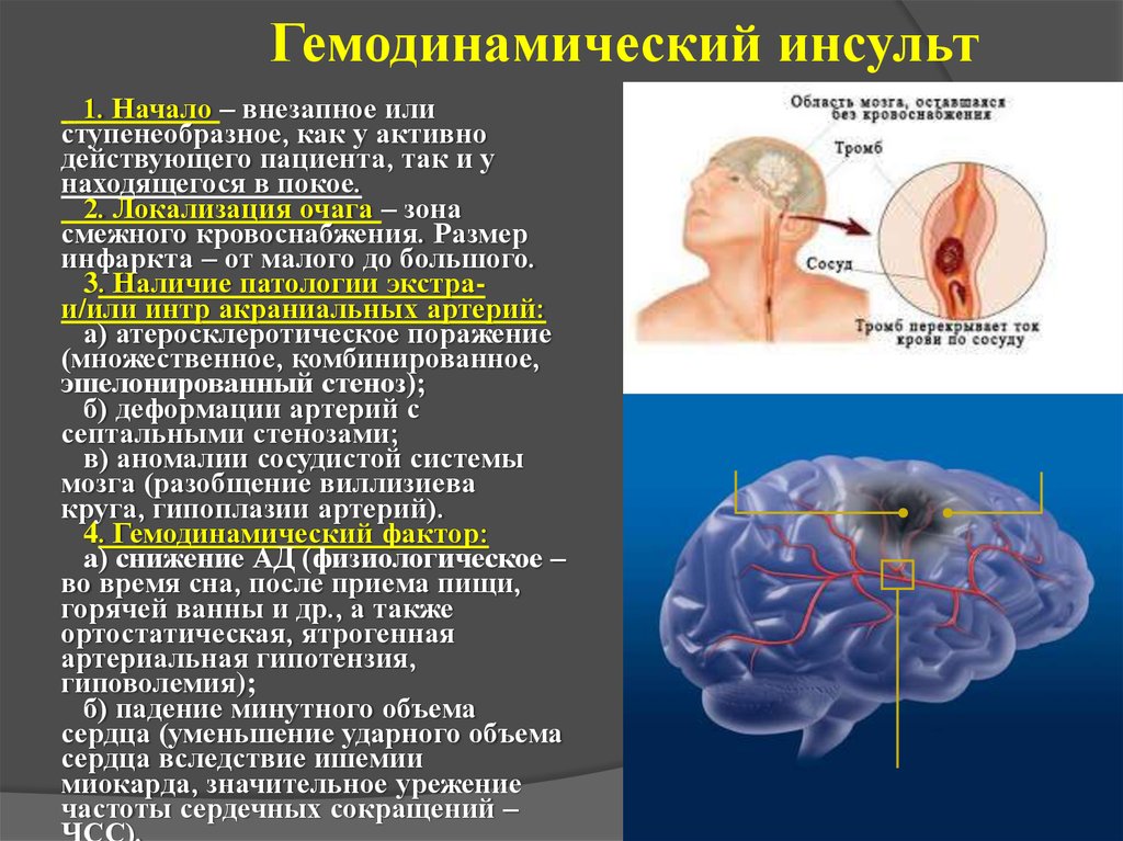 Последствия микроинсульта головного мозга