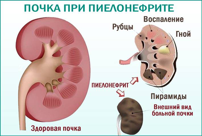 Клиническая картина заболеваний почек