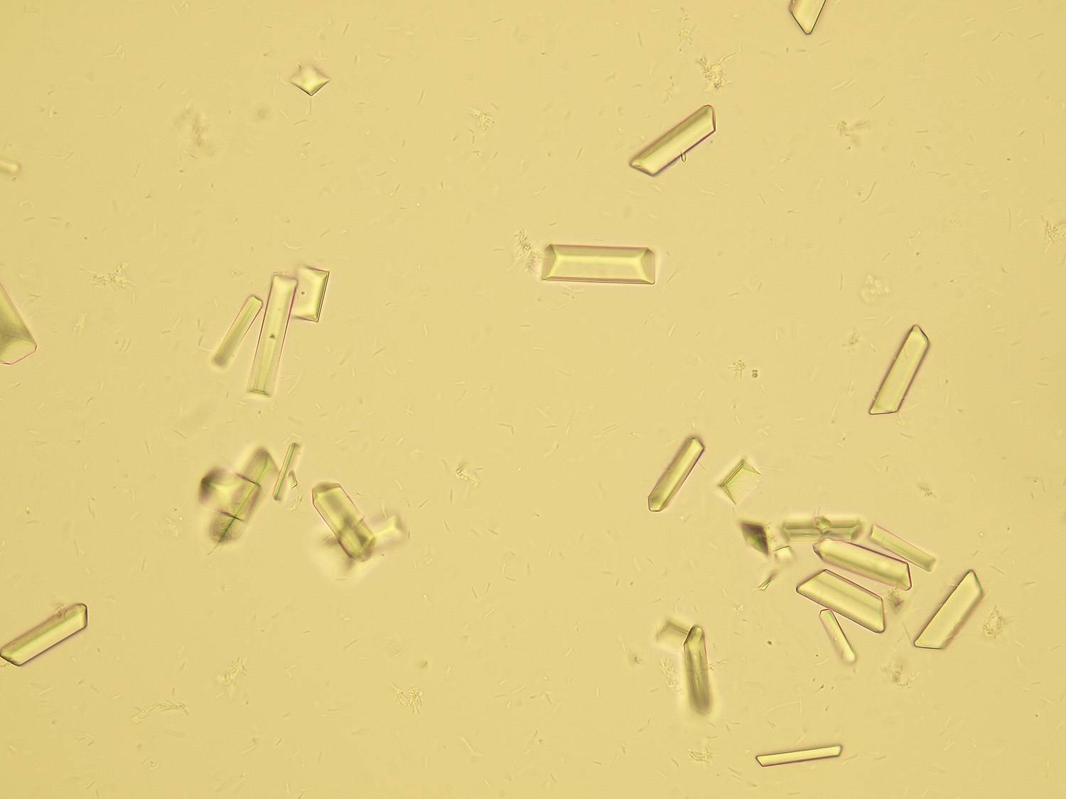 Кристаллы оксалаты в моче большое. Струвиты оксалаты трипельфосфаты. Струвиты и оксалаты. Струвиты микроскопия. Кристаллы трипельфосфаты в моче.