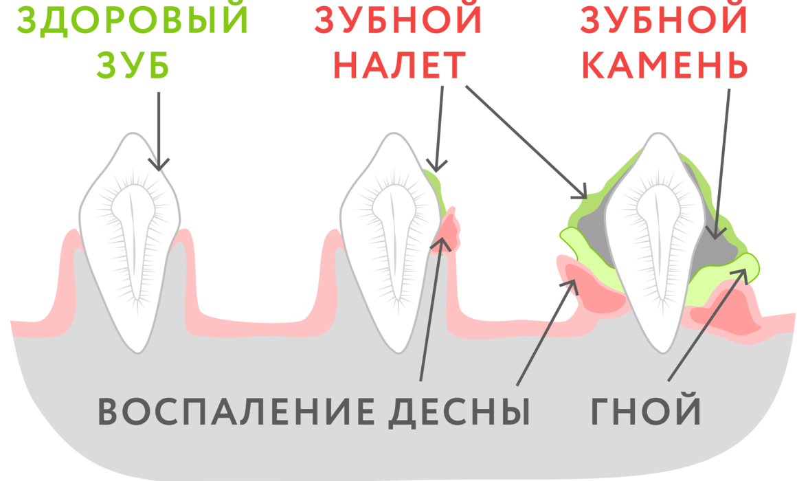 Зубной камень: что это такое и зачем его удалять?