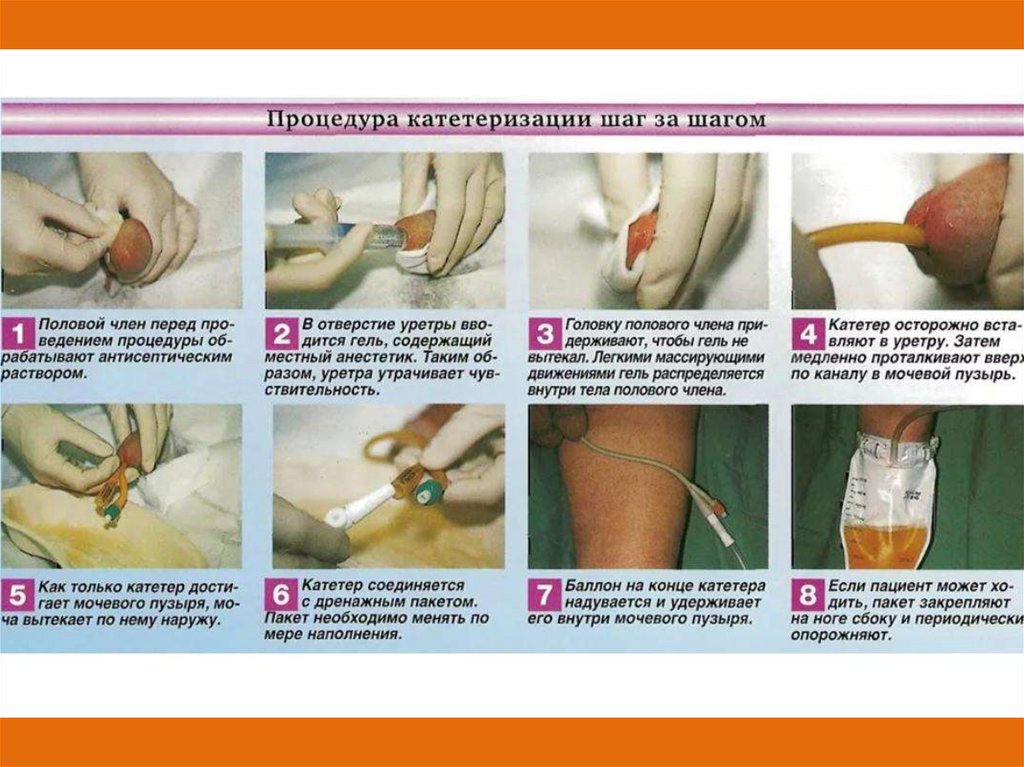 Уход за мочевым катетером картинки