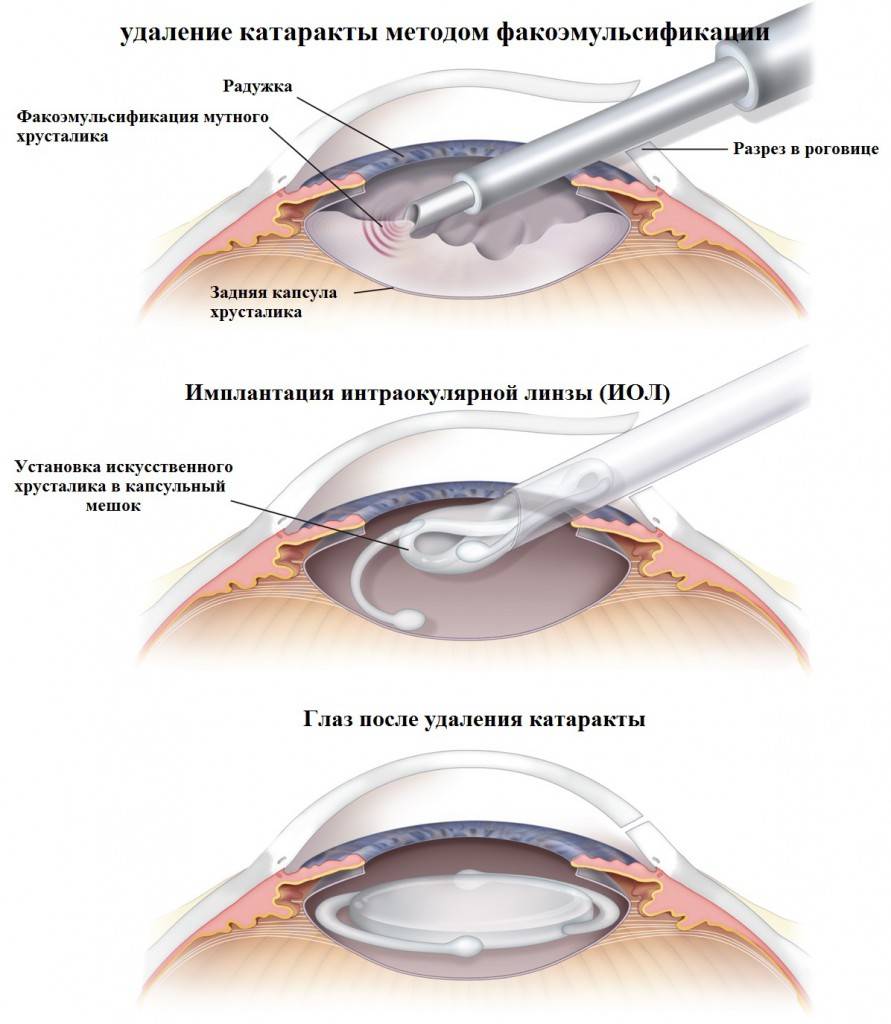 Энуклеация глазного яблока у кошки