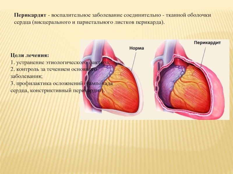 Лечение перикардита презентация