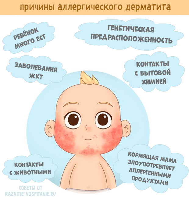 Аллергия у детей: признаки, причины и лечение
