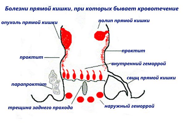 Геморроидальные кровотечения карта вызова