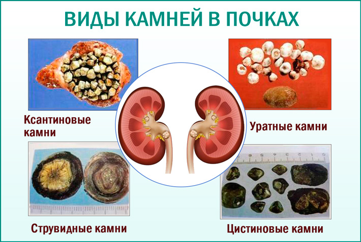 Образцы камней в почках