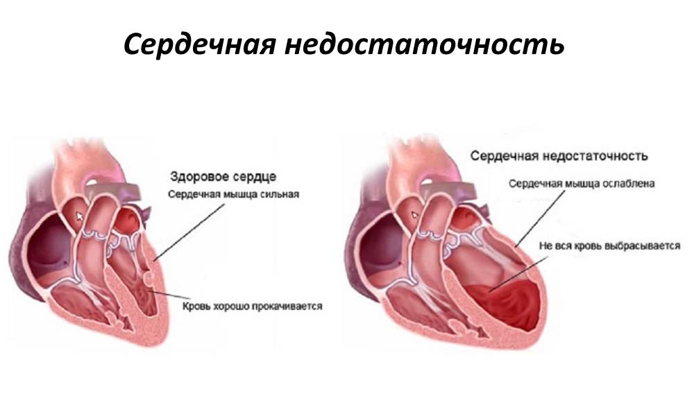 Хроническая сердечная недостаточность (хсн): причины, диагностика и лечение болезни
