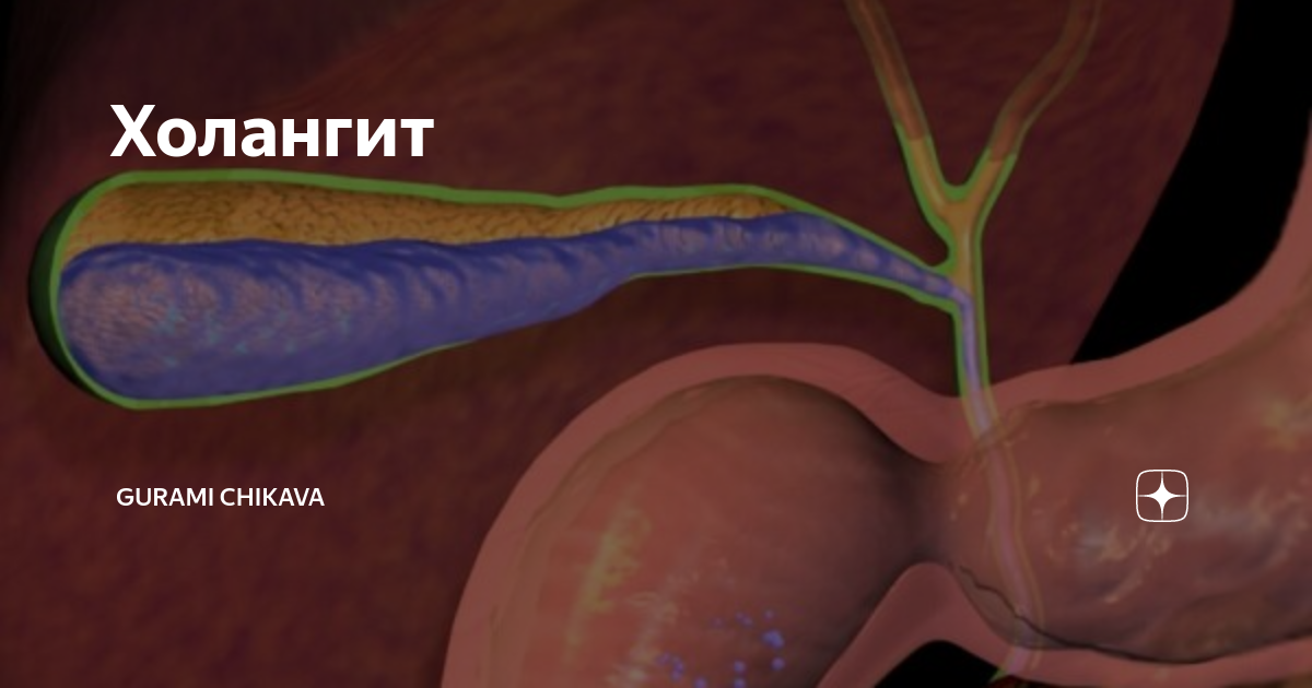 Гнойный холангит презентация