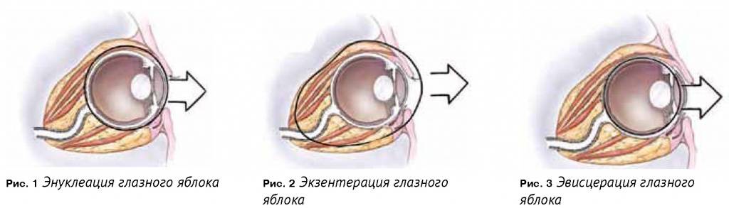 Послеоперационная обработка глаз