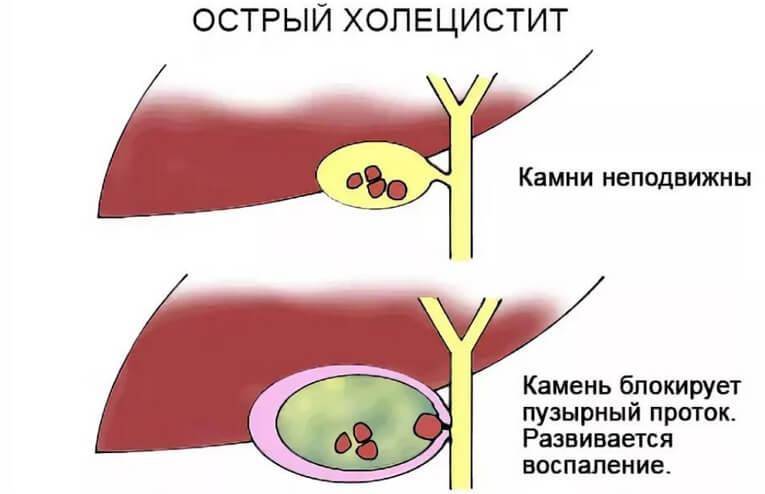 Холецистит первичное заболевание билиарной системы