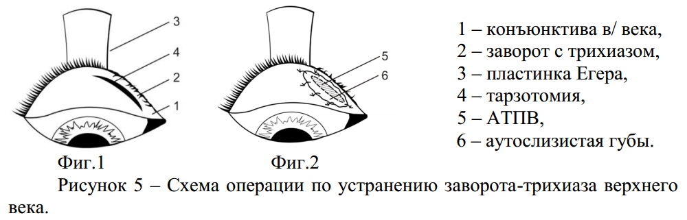 Кис век. Схема операции заворота века. Энтропион заворот века. Техника операции при завороте век.