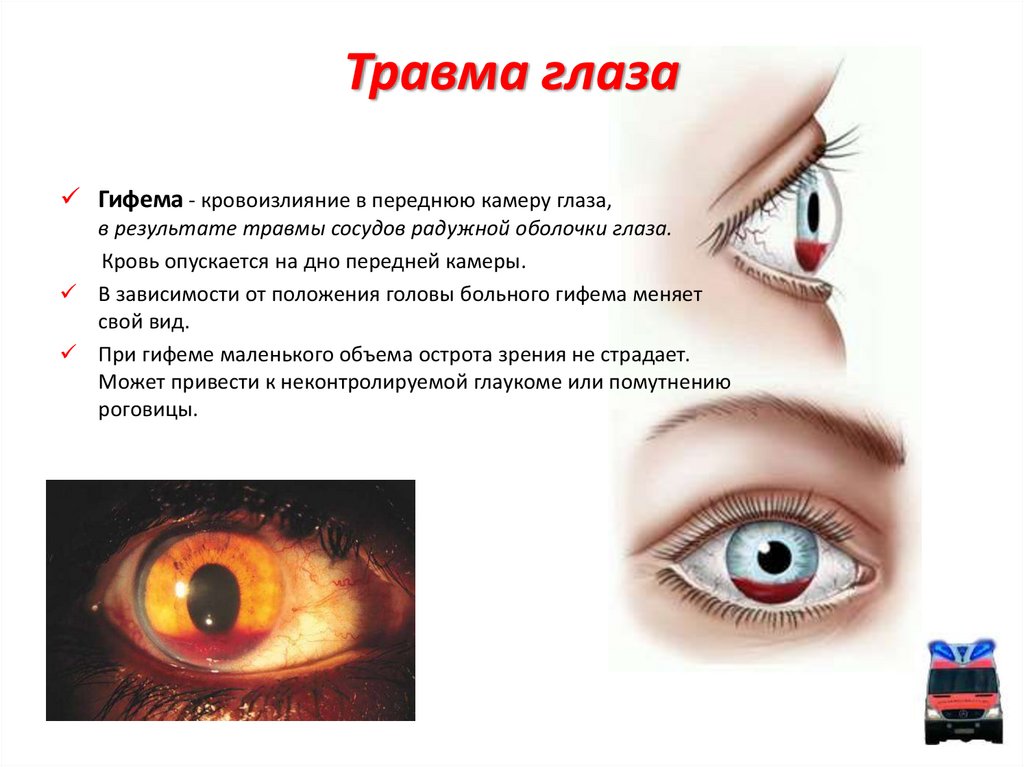 Карта вызова глаукома