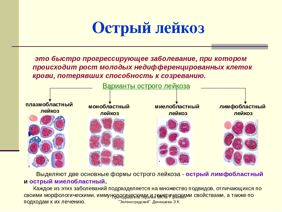 Т-клеточный лейкоз-лимфома взрослых - симптомы болезни, профилактика и лечение т-клеточного лейкоза-лимфомы взрослых, причины заболевания и его диагностика на eurolab
