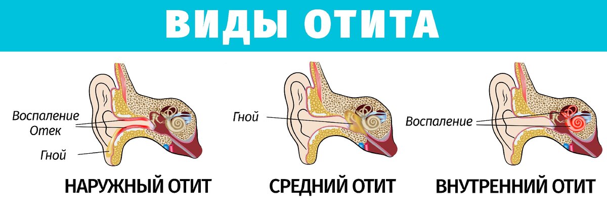 Частые отиты у детей. что делать?
