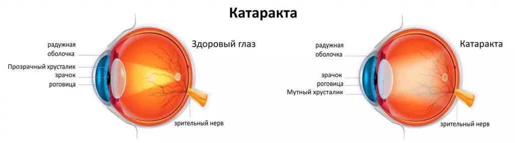 Мутное изображение в одном глазу