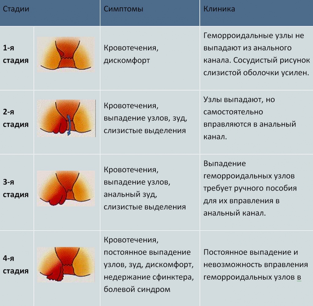 Как лечить внешний геморрой у женщин препараты схема лечения